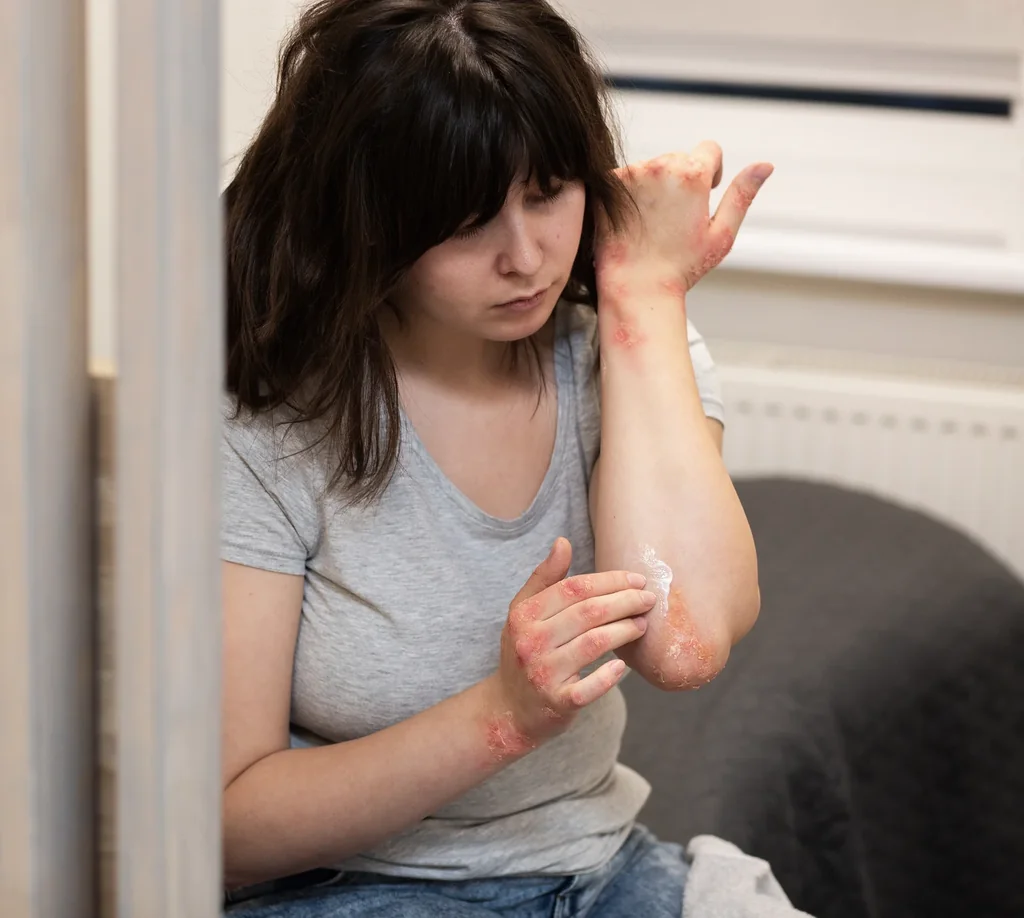 Psoriasis at AgeRejuvenation