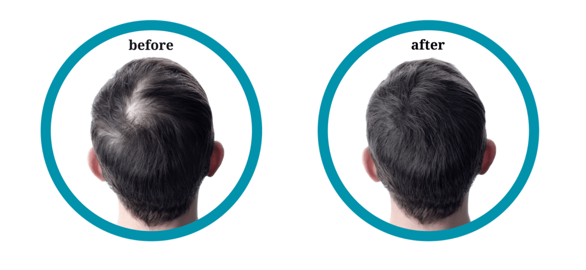 before-and-after-hair-loss-treatment